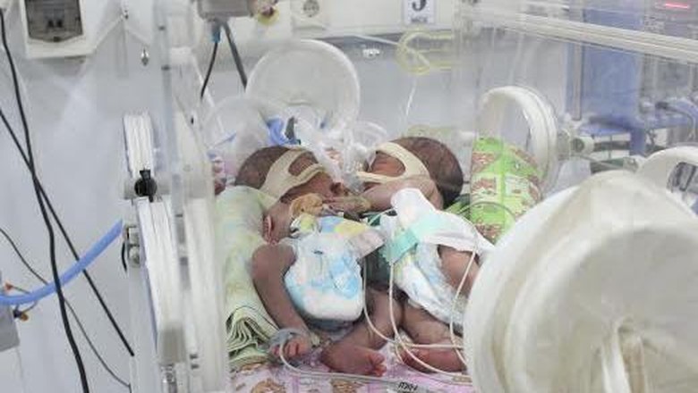 Bayi Kembar Siam Dempet Perut Lahir di Sidoarjo