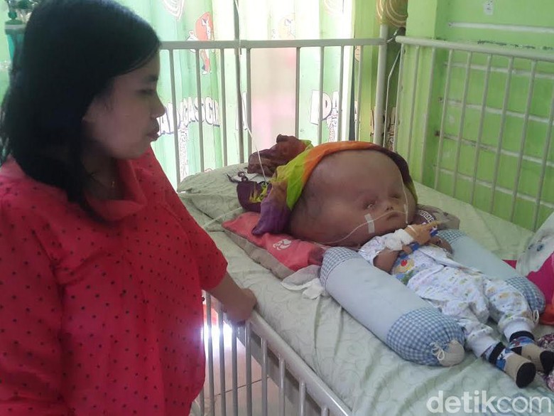 Kepala Makin Membesar, Balita di Banyuwangi ini Butuh Bantuan Kepala Makin Membesar, Balita di Banyuwangi ini Butuh Bantuan