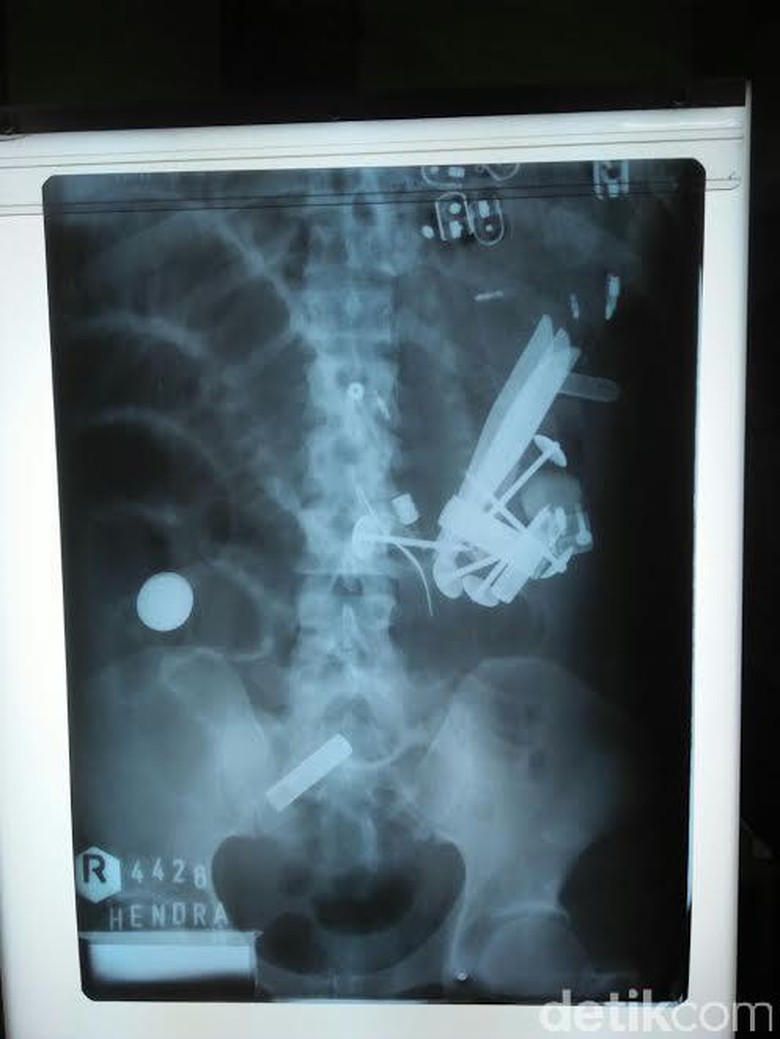 Dokter Berhasil Keluarkan Benda Tajam di Perut Hendro, Ini Isinya Dokter Berhasil Keluarkan Benda Tajam di Perut Hendro, Ini Isinya